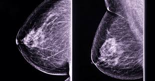 Durante todo octubre harán mamografías gratis para detectar el cáncer de mama